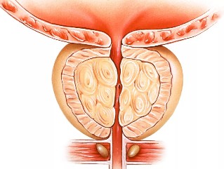 Prostate inflammation
