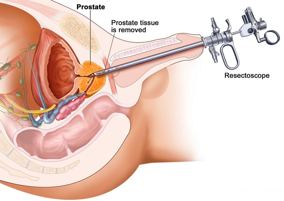 Prostate tissue collection for accurate diagnosis of prostatitis